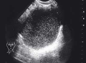 Эхограмма нагноившейся бронхогенной кисты верхней трети центрального средостения справа у ребенка, 12 лет