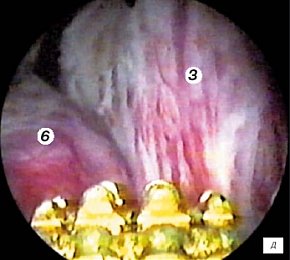 Эндоскопическая картина простатического отдела уретры - средняя доля гиперплазии простаты