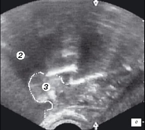 Эхограмма простаты (сагитальная проекция). Дистальный конец резектоскопа находится на средней доле гиперплазии простаты