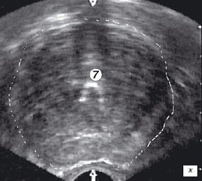 Эхограмма простаты (поперечная проекция). Дистальный конец резектоскопа находится на 1 см выше семенного бугорка