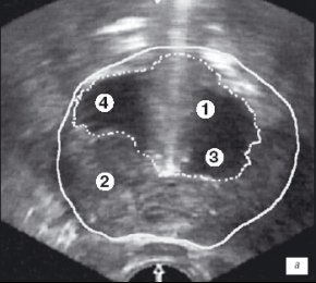 Эхограмма простаты (поперечная проекция)