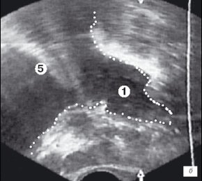 Эхограмма простаты (сагиттальная проекция)
