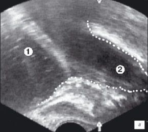 Эхограмма простаты (сагиттальная проекция)