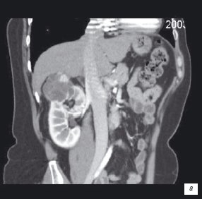 Компьютерная томограмма: кистозный рак почки