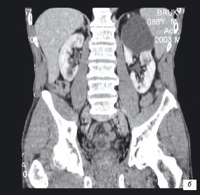 Компьютерная томограмма: рак в кисте почки