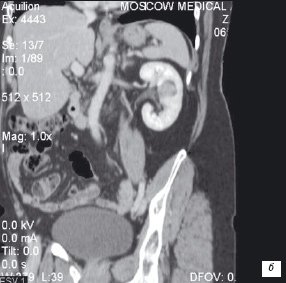 Компьютерная томограмма почки. Образование в почке интенсивно контрастируется