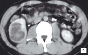 КТ после контрастного усиления: кистозное внутрипочечное образование в среднем и нижнем сегментах правой почки с перегородками и участками солидных включений