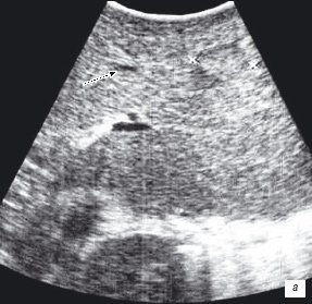 Метастатические очаги в печени - интраоперационная ультразвуковая томография (а)