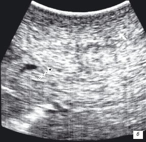 Метастатические очаги в печени - интраоперационная ультразвуковая томография (б)