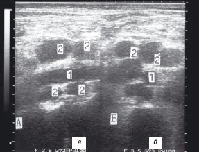 Эхограмма парааортальных лимфатических узлов