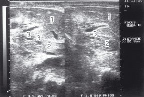 Эхограмма тромба нижней полой вены