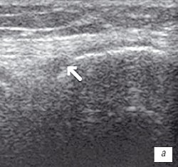 УЗИ коленного сустава: деформирующий остеоартроз, II стадия, гиалиновый хрящ неравномерно истончен до 1,2 мм