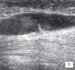 УЗИ коленного сустава: деформирующий остеоартроз, II стадия, однородный выпот в икроножной сумке