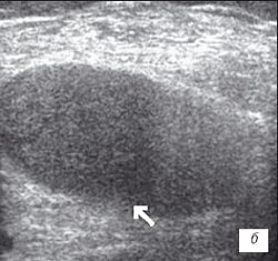 УЗИ коленного сустава: ревматоидный артрит, III стадия