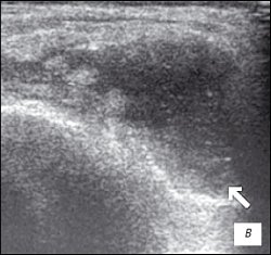 УЗИ коленного сустава: ревматоидный артрит, III стадия