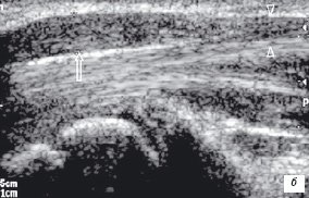 Веретеннообразное расширение срединного нерва (невринома - стрелка)