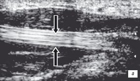 Сонограмма сухожилия сгибателя 1 пальца кисти - продольный срез