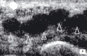 Гипоэхогенные зоны в местах прохождения сухожилий сгибателей