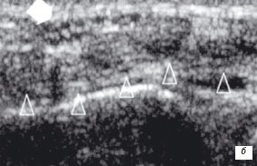Гиперэхогенная структура сухожилий