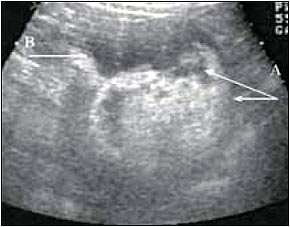 Ультрасонограмма правой почки: А - анэхогенная жидкость, В - гиперэхогенное образование