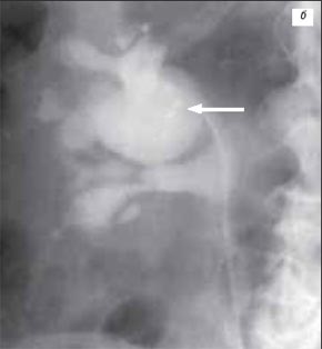 Крупный дивертикул лоханки правой почки на ретроградной пиелограмме