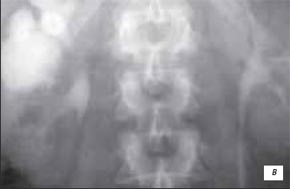 Гигантский дивертикул верхней чашечки правой почки с феноменом кальциевого молока на экскреторной урографии