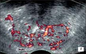 Рак предстательной железы ТРУЗИ, энергетический допплер