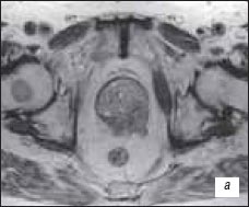 МРТ - метастазы в костях таза и правой бедренной кости