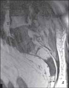 МРТ - пояснично-крестцовый отдел позвоночника