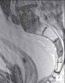 МРТ - пояснично-крестцовый отдел позвоночника