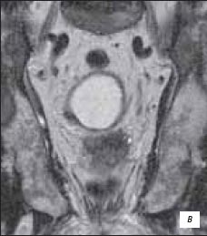 МРТ - рак предстательной железы