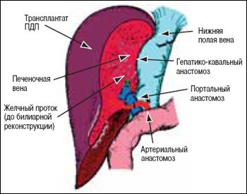 Трансплантат правой доли печени