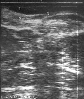 Ультрасонограмма продольного сечения анального канала