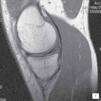 МРТ повреждения заднего рога мениска