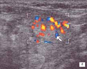 Перинодулярный кровоток что это. Аденома щитовидной железы на УЗИ. Фолликулярная аденома щитовидной железы УЗИ. Цветное допплеровское картирование щитовидной железы. Васкуляризация узла Перинодулярная.