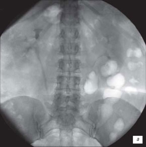 Экскреторная урография в положении на спине