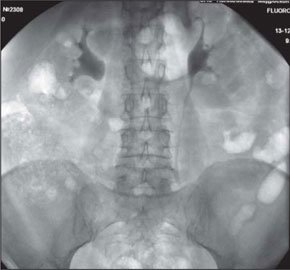 Экскреторная урография через 1 год после операции