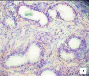 Гистологические препараты нодозной формы ДГПЖ до лизиса