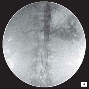 Нефроартериография левой почки