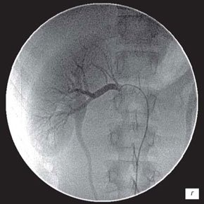 Нефроартериография правой почки