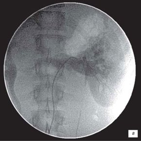 Нефроартериография левой почки