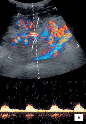 Эхографическая картина извитости почечной артерии