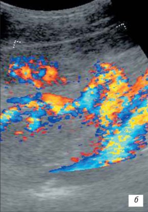 Эхографическая картина извитости почечной артерии