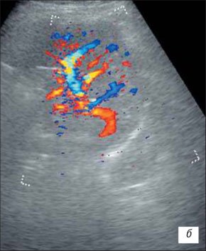 УЗИ почки в режиме ЦДК - обеднение сосудистого рисунка