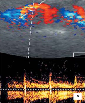 УЗИ почки в режиме ЦДК - скоростные показатели в устье почечной артерии