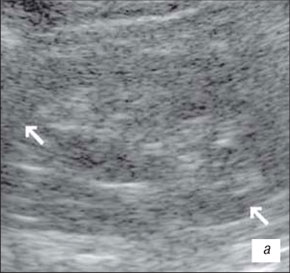 Эхограмма гипоплазии почки в В-режиме