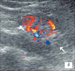 Эхограмма гипоплазии почки в режиме ЦДК