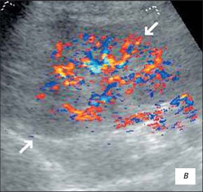 Эхограмма гипоплазии почки в режиме ЦДК
