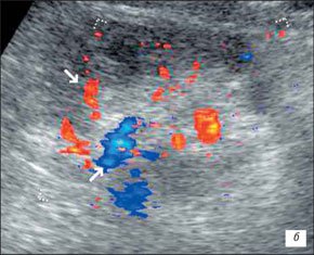 Эхограмма сморщенной почки в режиме ЦДК