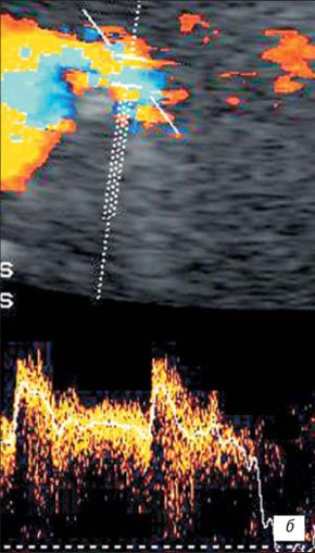 УЗИ в режиме ЦДК артериовенозной мальформации